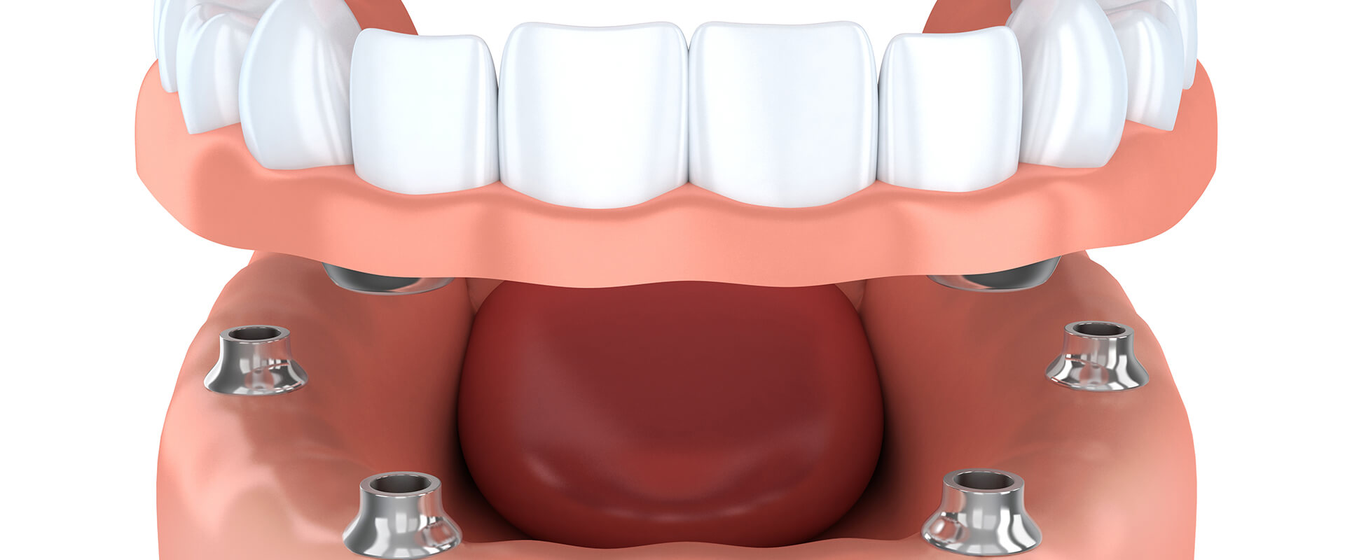 Implante Dentário Dói Saiba Como é Feito Passo A Passo 3488