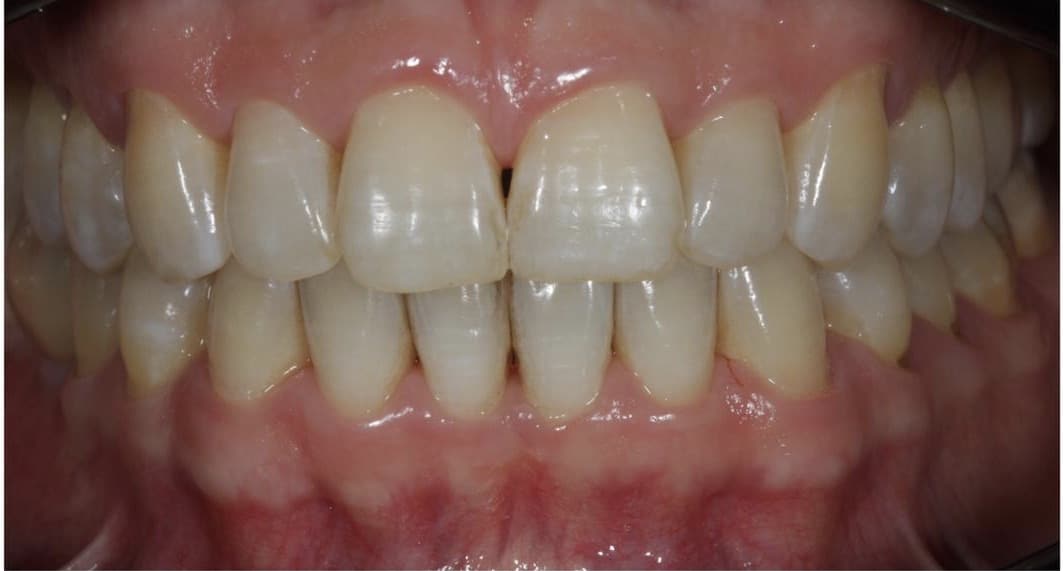 clareamento dental a laser antes e depois-01