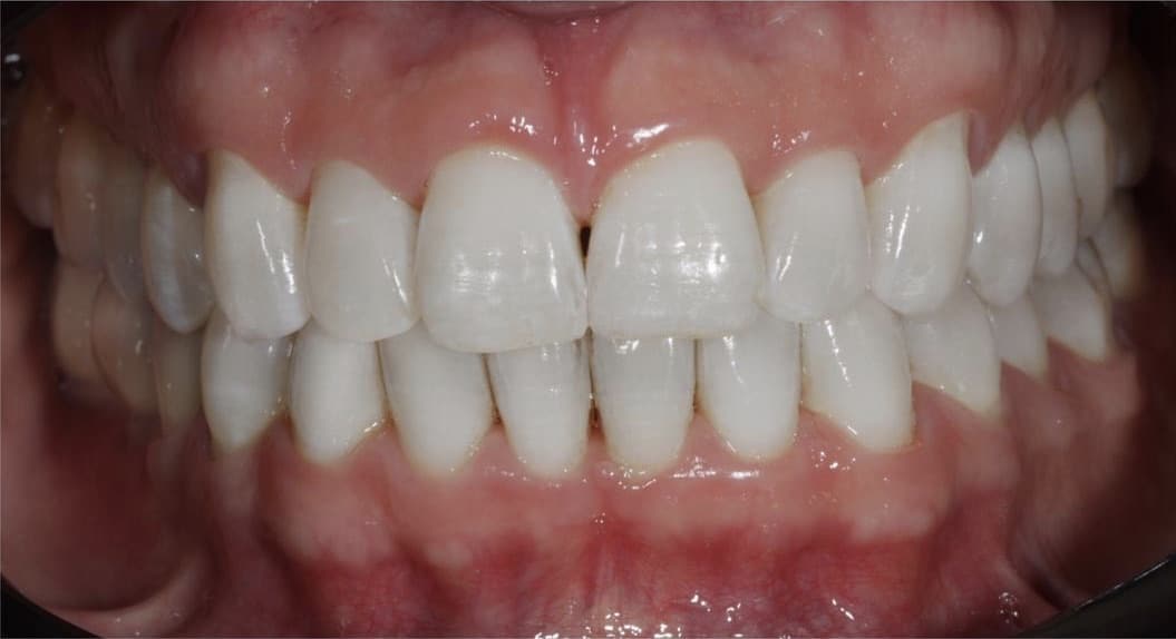 clareamento dental a laser antes e depois-02