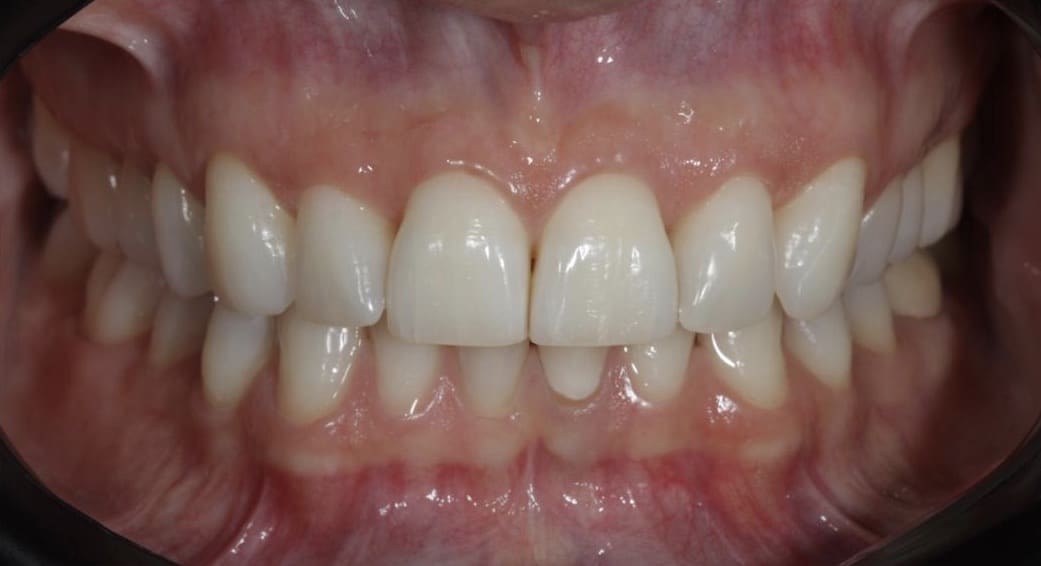 clareamento dental a laser antes e depois-03