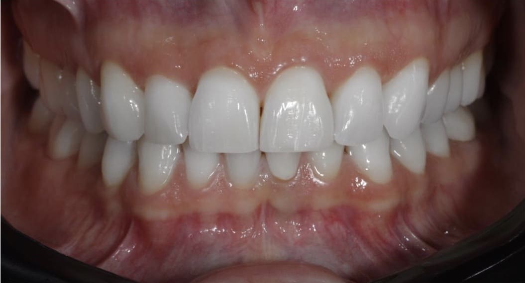 clareamento dental a laser antes e depois-04